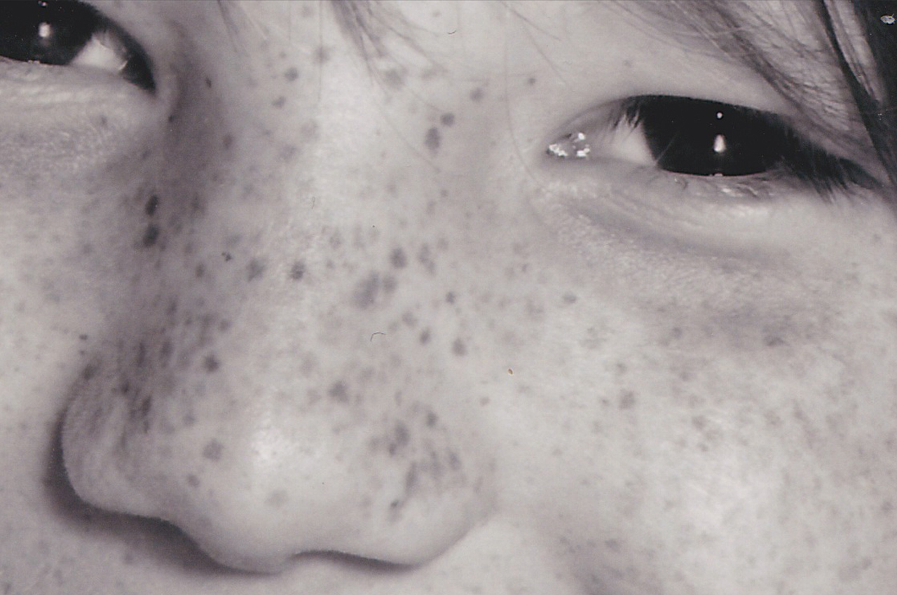 Fabulous Freckles, Lousy Liver Spots